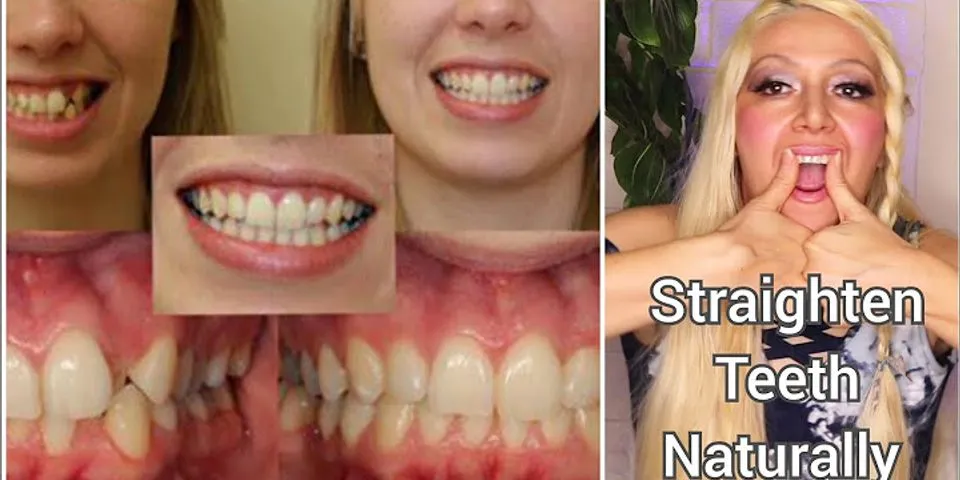 Can teeth straighten naturally