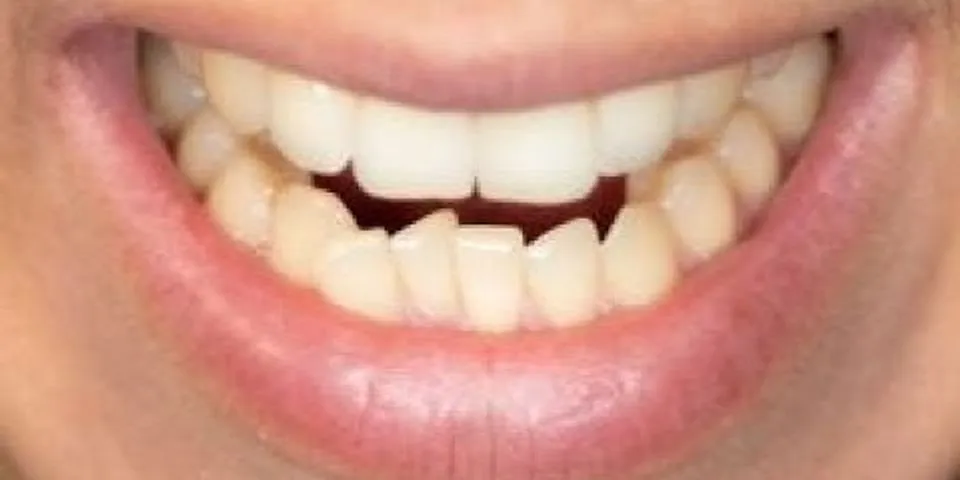 Do your teeth move more at night with braces?