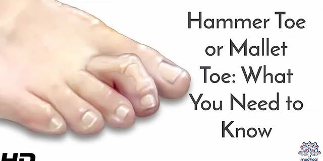 hammer toe là gì - Nghĩa của từ hammer toe