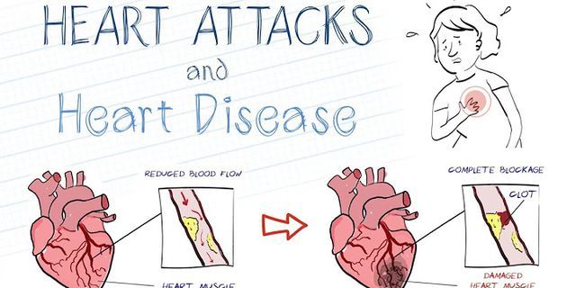 heartattack là gì - Nghĩa của từ heartattack