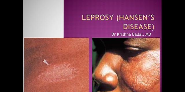 leprosy là gì - Nghĩa của từ leprosy