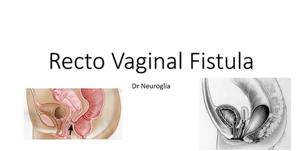recto-vaginal fistula là gì - Nghĩa của từ recto-vaginal fistula